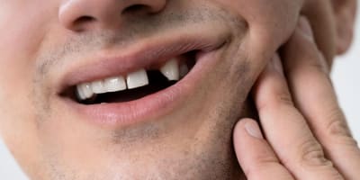 Exploring Missing Tooth Solutions at Okanagan Dentistry